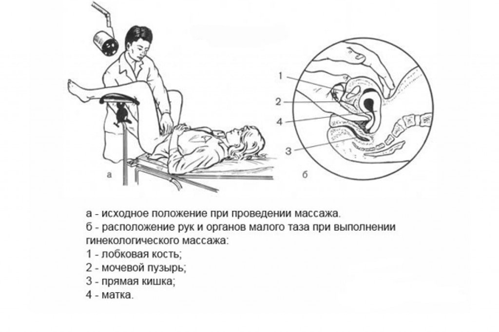 Фото: Массаж гинекологический при загибе