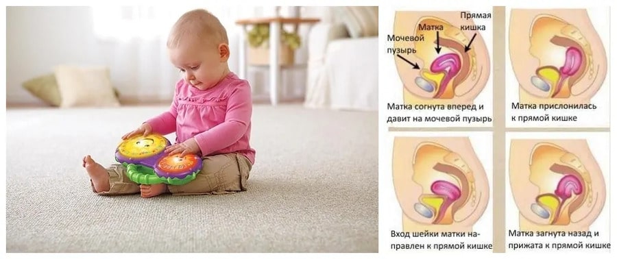 Фото: Загиб матки и раннее присаживание